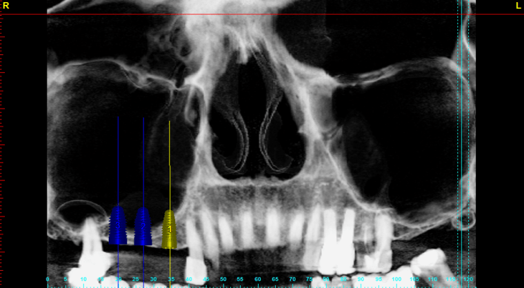 Pan with Implants.png